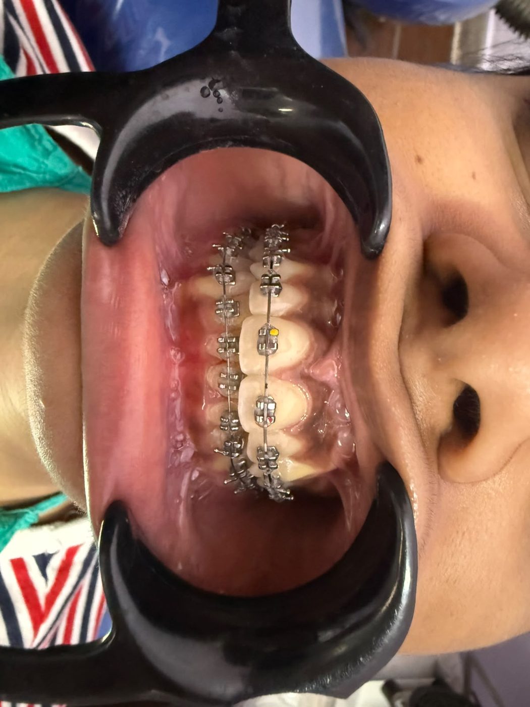 Clear Aligners & Braces at Happy Tooth Dental Care, Mohamadwadi, Pune